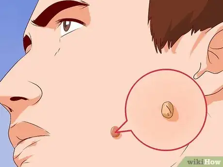 Image intitulée Get Rid of Ingrown Hair Scars Step 8