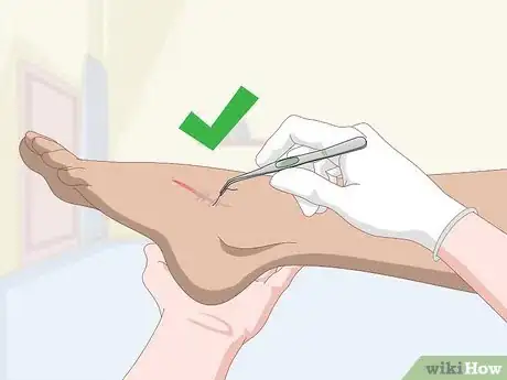Image intitulée Get Rid of Scars Step 18