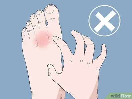 Image intitulée Cure Athlete's Foot Naturally Step 8