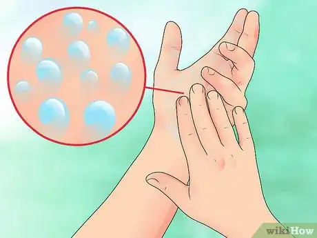 Image intitulée Detect an Aneurysm Step 13