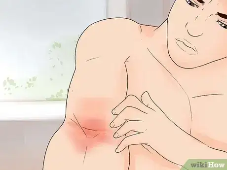 Image intitulée Treat Eczema Naturally Step 21