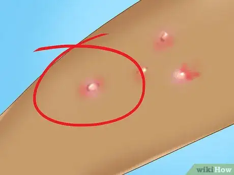 Image intitulée Recognize Molluscum (Molluscum Contagiosum) Step 3