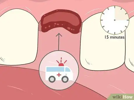 Image intitulée Pull a Loose Tooth at Home Step 15