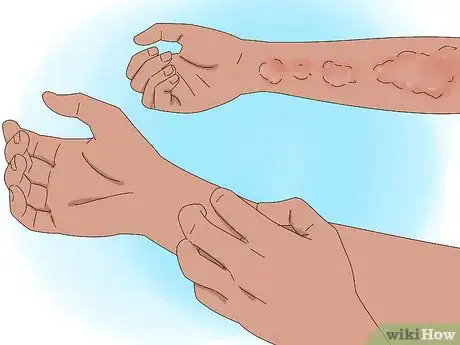 Image intitulée Diagnose Lymphoma Step 5