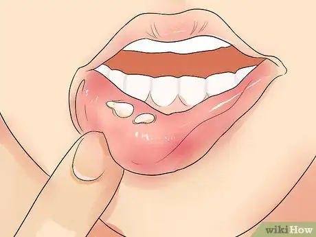 Image intitulée Recognize Herpes Step 1