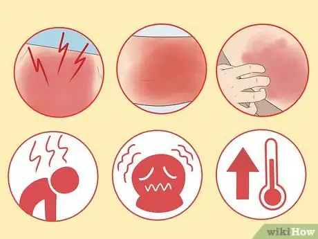 Image intitulée Treat Cellulitis Step 2
