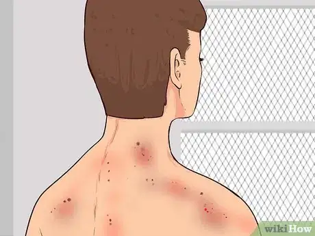 Image intitulée Recognize Radiation Sickness Step 1
