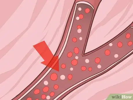 Image intitulée Diagnose Fanconi Anemia Step 11