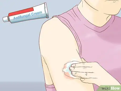Image intitulée Treat a Skin Fungal Infection Step 2