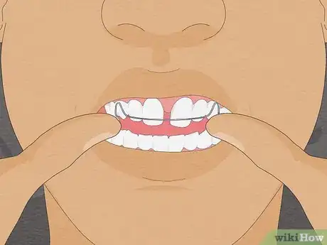Image intitulée Fix Crooked Teeth Step 7