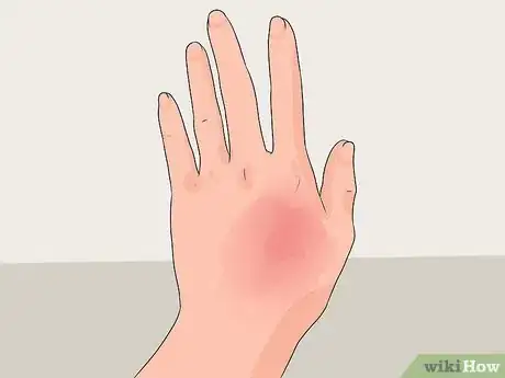 Image intitulée Treat a Hand Burn Step 4