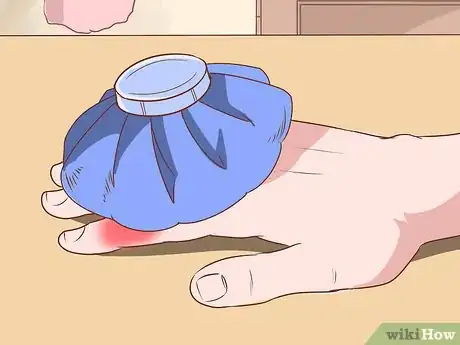 Image intitulée Deal With the Pain of a Door Being Shut on Your Finger Step 1