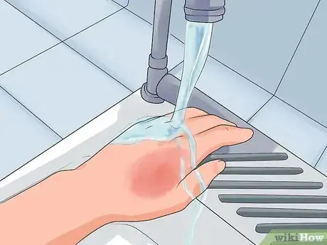 Image intitulée Treat a Hand Burn Step 5