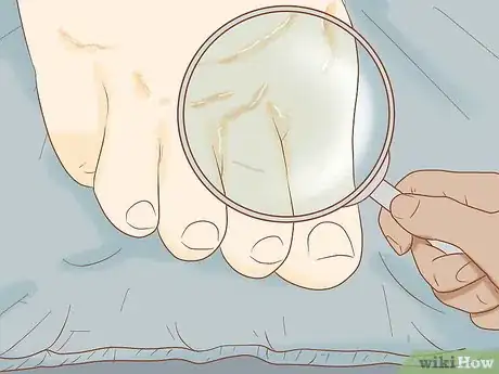 Image intitulée Treat a Skin Fungal Infection Step 4
