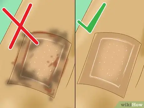 Image intitulée Treat a Skin Flap or Abrasion During First Aid Step 8