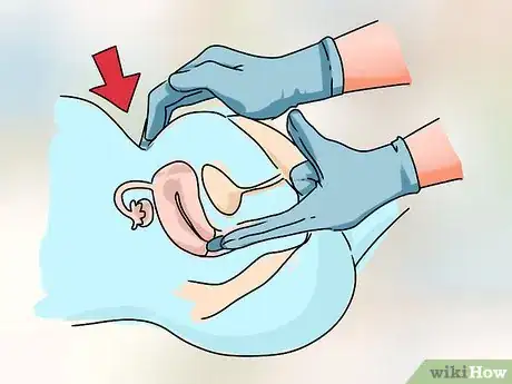 Image intitulée Know the Signs of Miscarriage Step 5