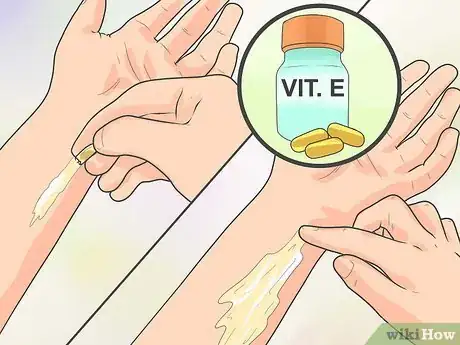Image intitulée Naturally Stop Granuloma Annulare Step 1