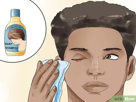 Image intitulée Get Rid of a Stye Step 8