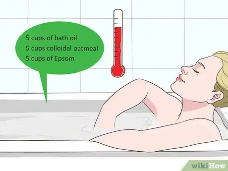 Image intitulée Treat Psoriasis Naturally Step 20