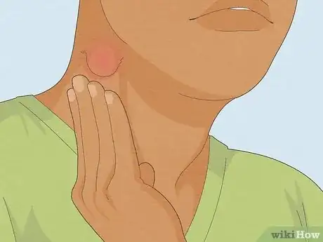 Image intitulée Reduce Lymph Node Swelling Step 1