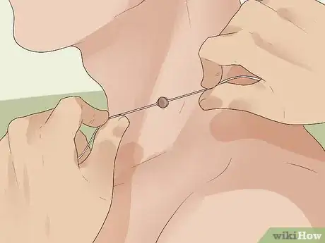Image intitulée Get Rid of Skin Tags Step 20