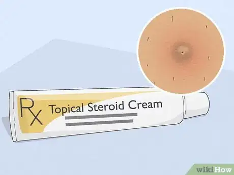 Image intitulée Remove an Ingrown Hair Under the Skin Step 11