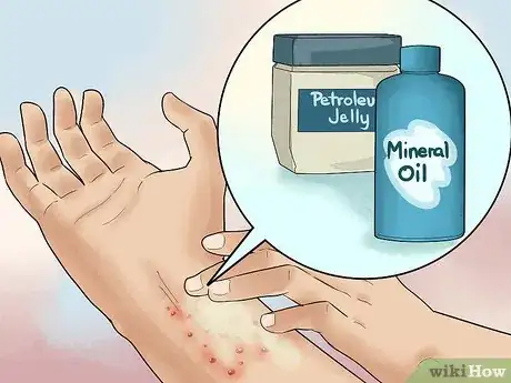 Image intitulée Treat Dyshidrotic Eczema Step 4
