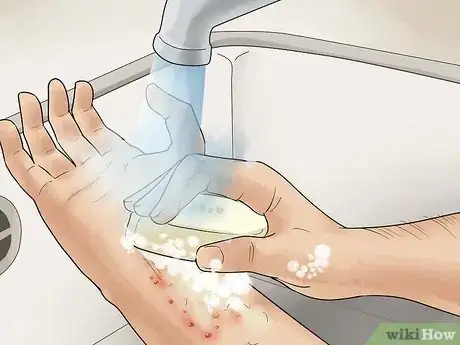 Image intitulée Treat Dyshidrotic Eczema Step 7