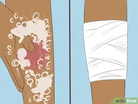 Image intitulée Treat Cellulitis Step 5