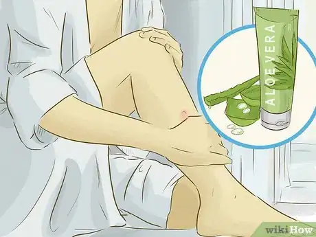 Image intitulée Get Rid of Keloids Step 1