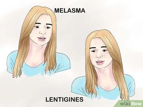 Image intitulée Treat Hyperpigmentation Step 1