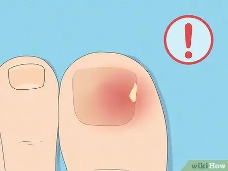 Image intitulée Remove a Dead Toenail Step 16