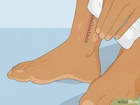 Image intitulée Take a Shower After Surgery Step 4