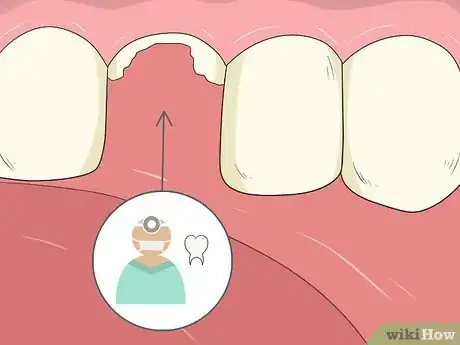 Image intitulée Pull a Loose Tooth at Home Step 14