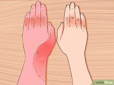 Image intitulée Treat a Facial Burn from a Curling Iron to Prevent Scars Step 7