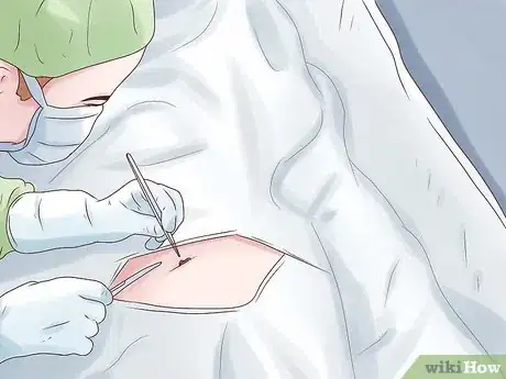 Image intitulée Treat a Hiatal Hernia Step 9