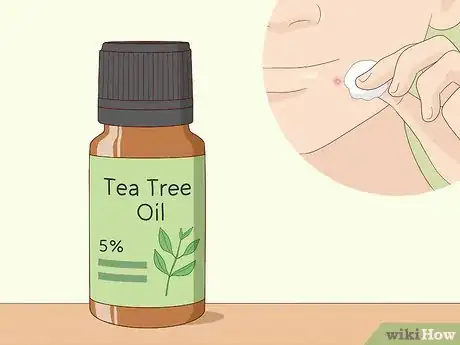 Image intitulée Treat Whiteheads Step 3