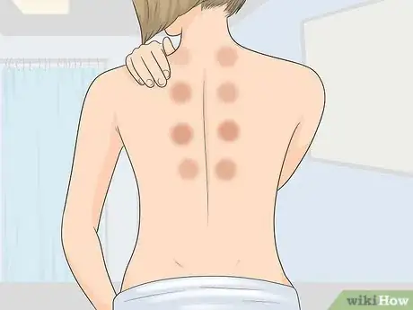 Image intitulée Do Cupping Step 13