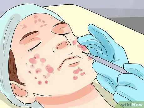 Image intitulée Decrease the Size of a Pimple Overnight Step 9