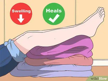 Image intitulée Fix Hyperextended Knees Step 7