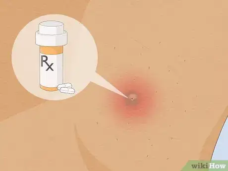 Image intitulée Remove an Ingrown Hair Under the Skin Step 12