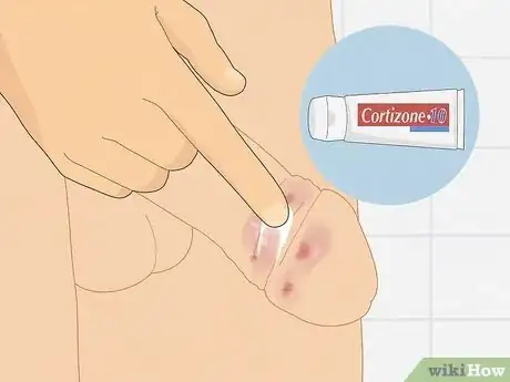 Image intitulée Cure Balanitis Step 3