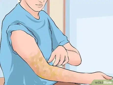 Image intitulée Prevent Lymphedema Step 18