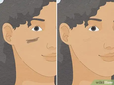 Image intitulée Remove Sharpie Ink from Skin Step 10