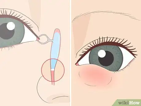 Image intitulée Clear a Blocked Tear Duct Step 1