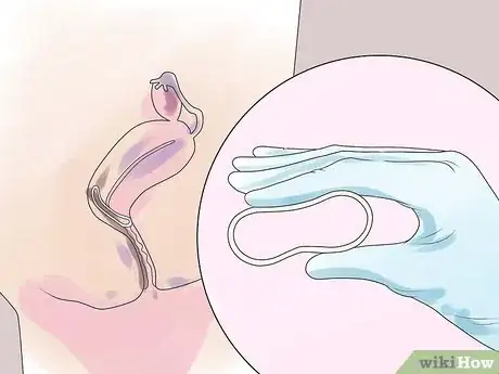 Image intitulée Get Birth Control Without Parents Knowing Step 8