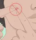 se débarasser d'un bouton en une nuit