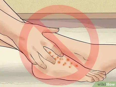 Image intitulée Treat Dyshidrotic Eczema Step 8