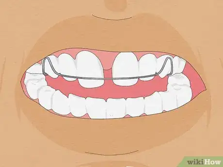 Image intitulée Fix Crooked Teeth Step 5