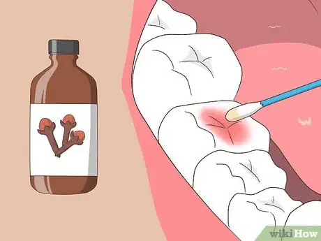 Image intitulée Cure a Toothache Step 10